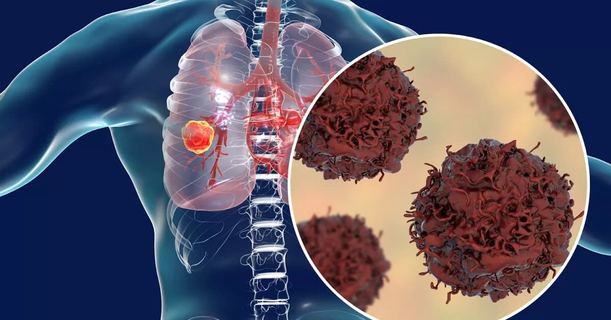 lung-cancer
