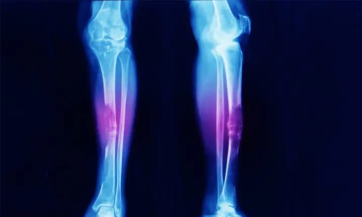 sarcoma